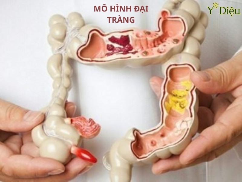Mô hình đại tràng, rối loạn vận động đại tràng là một nguyên nhân gây ra táo bón